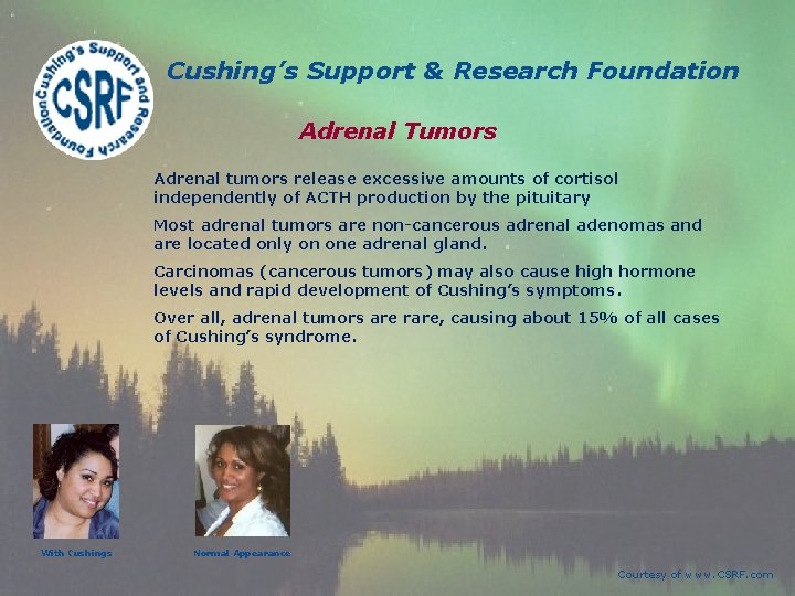 Cushing’s Support & Research Foundation Adrenal Tumors Adrenal tumors release excessive amounts of cortisol Cushing’s Support & Research Foundation Adrenal Tumors Adrenal tumors release excessive amounts of cortisol