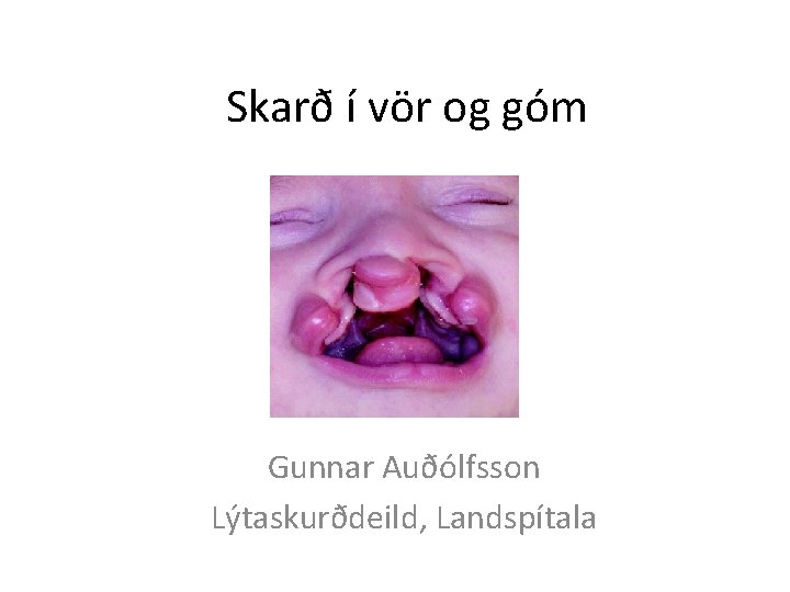 Skarð í vör og góm Gunnar Auðólfsson Lýtaskurðdeild, Landspítala 