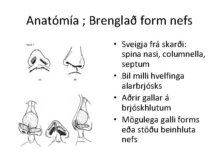 Anatómía ; Brenglað form nefs • Sveigja frá skarði: spina nasi, columnella, septum •