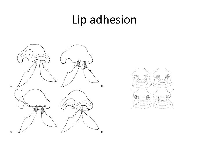 Lip adhesion 