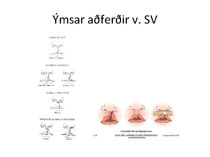Ýmsar aðferðir v. SV 