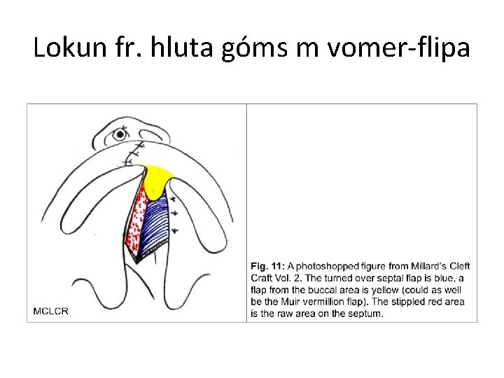 Lokun fr. hluta góms m vomer-flipa 