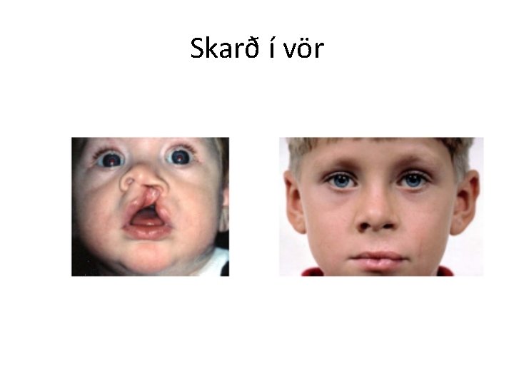 Skarð í vör 