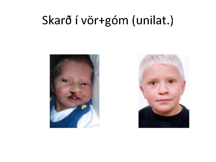 Skarð í vör+góm (unilat. ) 