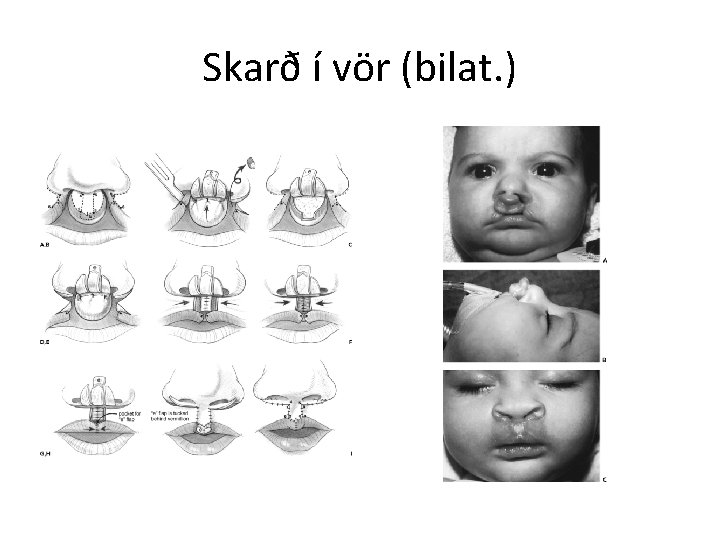 Skarð í vör (bilat. ) 