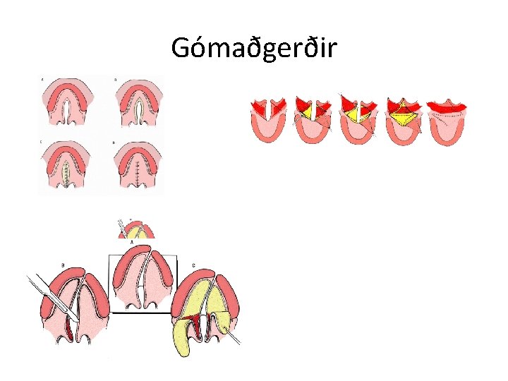 Gómaðgerðir 