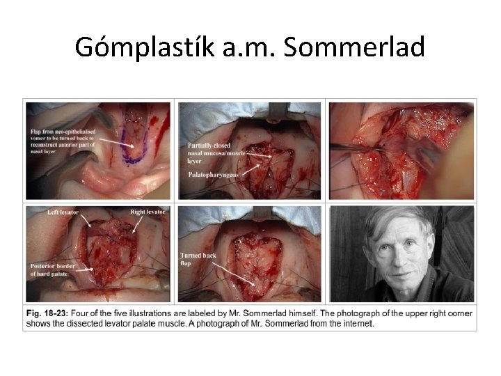 Gómplastík a. m. Sommerlad 