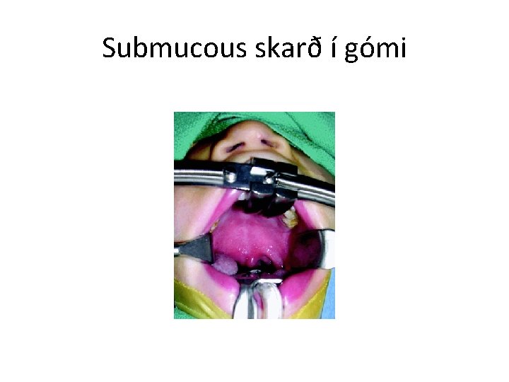 Submucous skarð í gómi 