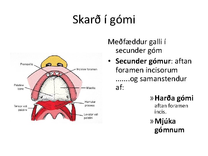 Skarð í gómi Meðfæddur galli í secunder góm • Secunder gómur: aftan foramen incisorum.