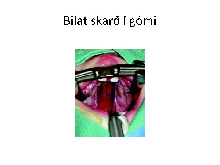 Bilat skarð í gómi 