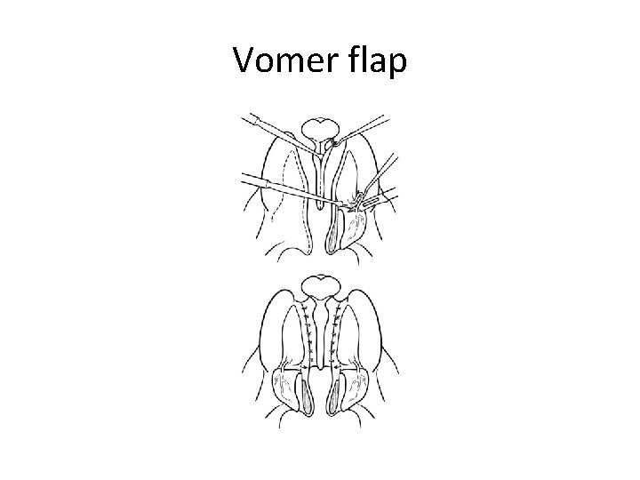 Vomer flap 