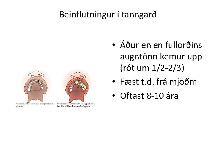 Beinflutningur í tanngarð • Áður en en fullorðins augntönn kemur upp (rót um 1/2