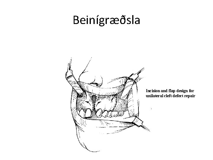 Beinígræðsla Incision and flap design for unilateral cleft defect repair 