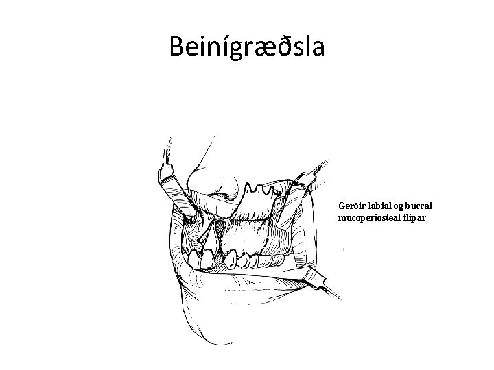 Beinígræðsla Gerðir labial og buccal mucoperiosteal flipar 