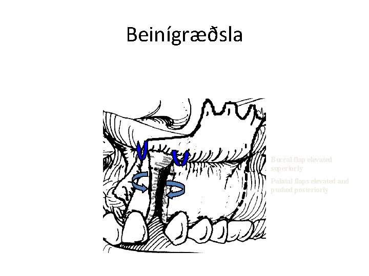 Beinígræðsla Buccal flap elevated superiorly Palatal flaps elevated and pushed posteriorly 