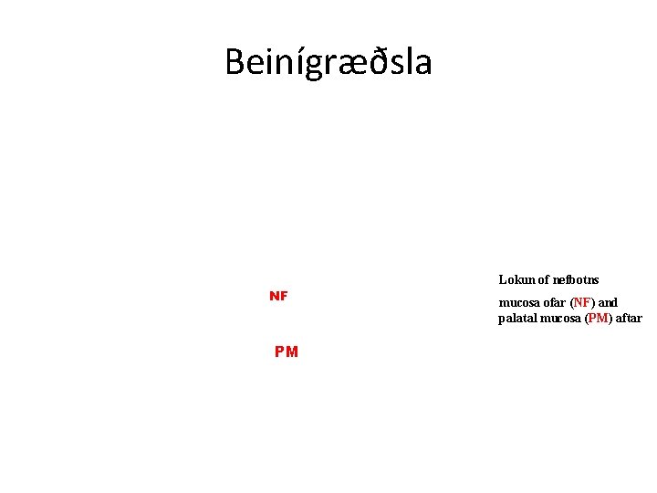 Beinígræðsla NF PM Lokun of nefbotns mucosa ofar (NF) and palatal mucosa (PM) aftar