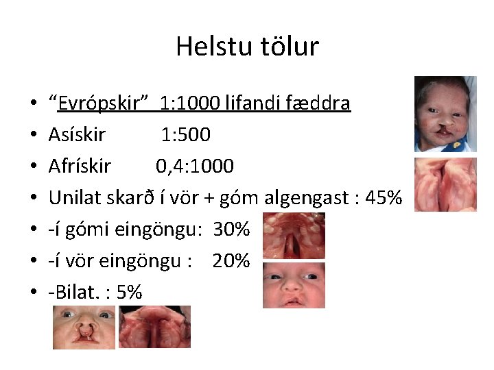 Helstu tölur • • “Evrópskir” 1: 1000 lifandi fæddra Asískir 1: 500 Afrískir 0,