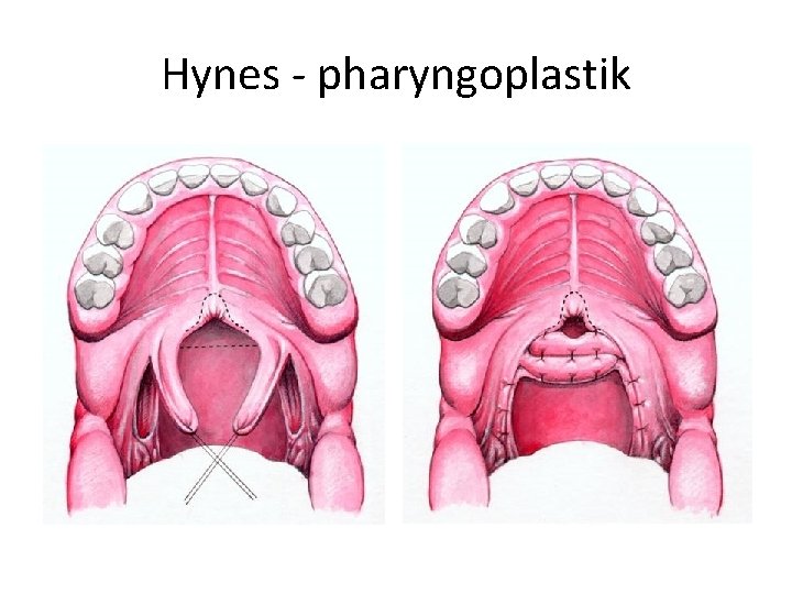 Hynes - pharyngoplastik 