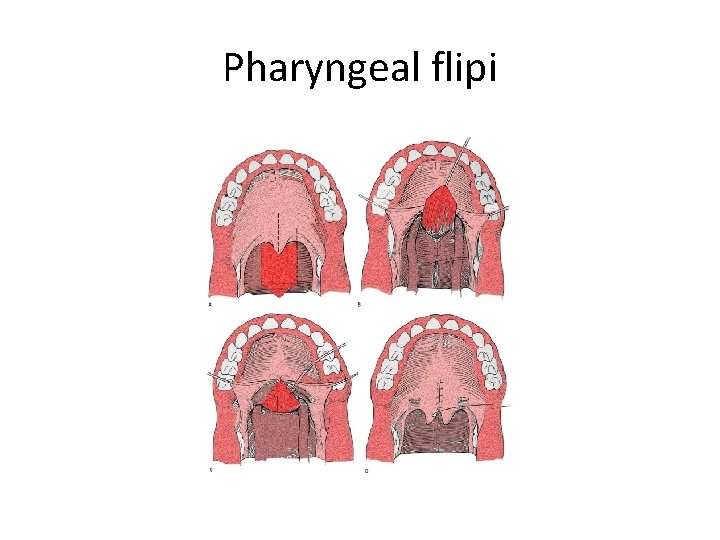 Pharyngeal flipi 
