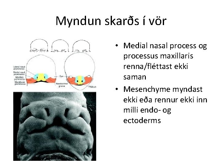 Myndun skarðs í vör • Medial nasal process og processus maxillaris renna/fléttast ekki saman