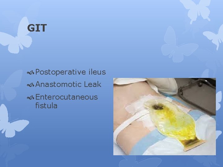 GIT Postoperative ileus Anastomotic Leak Enterocutaneous fistula 