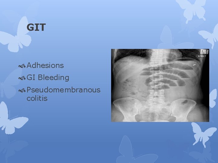 GIT Adhesions GI Bleeding Pseudomembranous colitis 