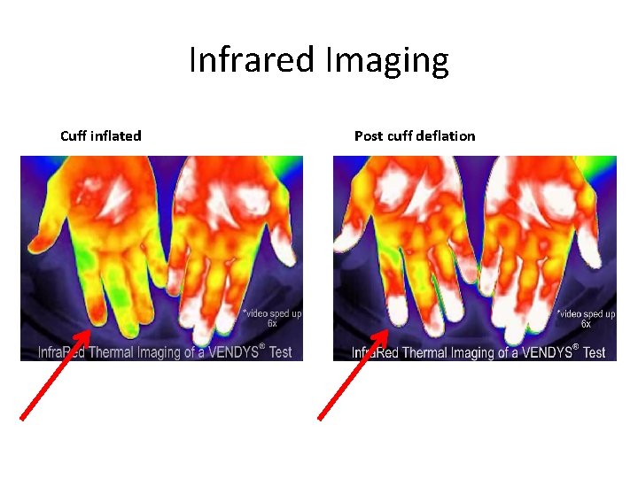 Infrared Imaging Cuff inflated Post cuff deflation 