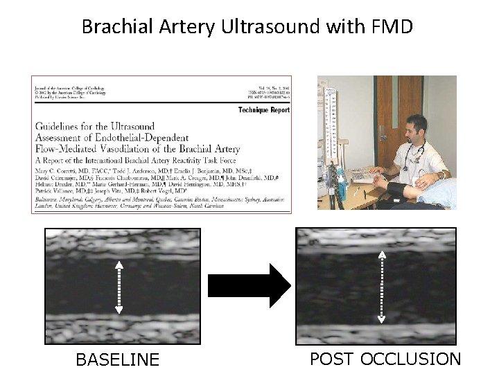 Brachial Artery Ultrasound with FMD BASELINE POST OCCLUSION 