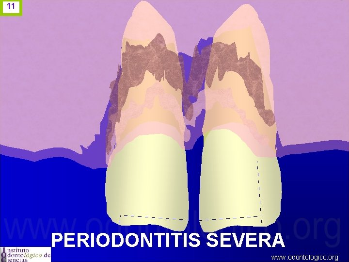 11 PERIODONTITIS SEVERA www. odontologico. org 