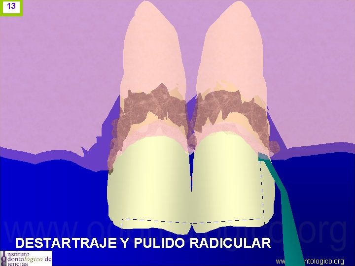 13 DESTARTRAJE Y PULIDO RADICULAR www. odontologico. org 