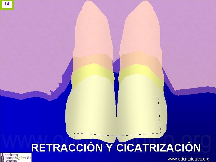 14 RETRACCIÓN Y CICATRIZACIÓN www. odontologico. org 