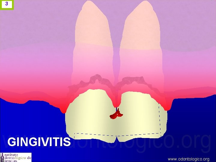 3 GINGIVITIS www. odontologico. org 