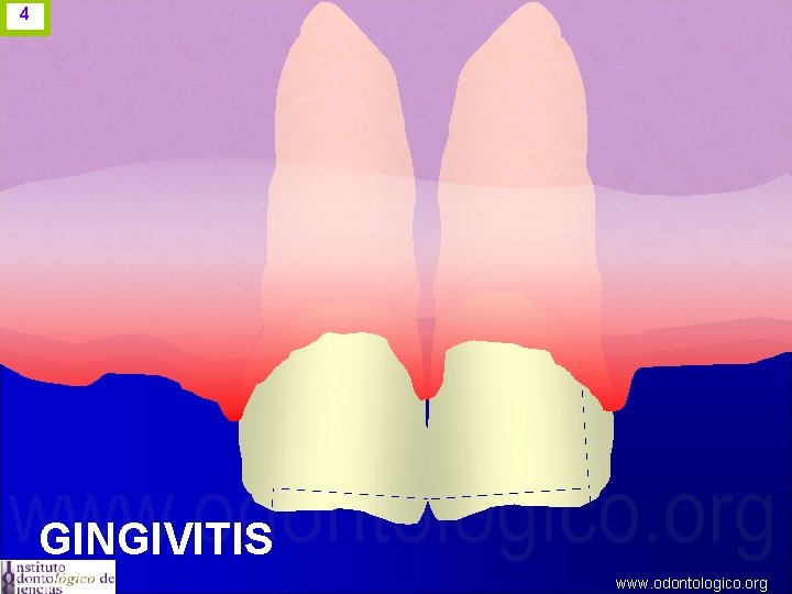 4 GINGIVITIS www. odontologico. org 