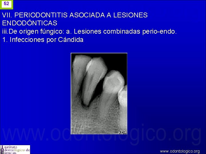 52 VII. PERIODONTITIS ASOCIADA A LESIONES ENDODÓNTICAS iii. De origen fúngico: a. Lesiones combinadas