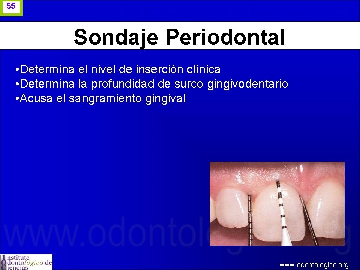 55 Sondaje Periodontal • Determina el nivel de inserción clínica • Determina la profundidad