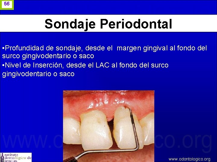 56 Sondaje Periodontal • Profundidad de sondaje, desde el margen gingival al fondo del