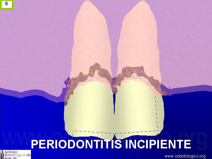 6 PERIODONTITIS INCIPIENTE www. odontologico. org 