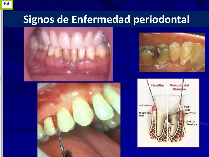 64 Signos de Enfermedad periodontal www. odontologico. org 