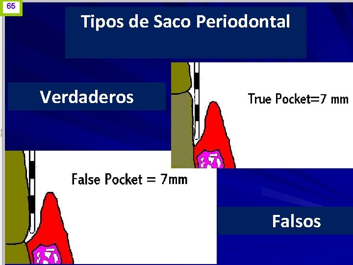 65 Tipos de Saco Periodontal Verdaderos Falsos www. odontologico. org 