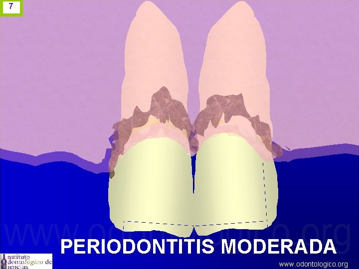 7 PERIODONTITIS MODERADA www. odontologico. org 