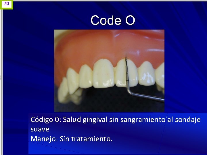 70 Código 0: Salud gingival sin sangramiento al sondaje suave Manejo: Sin tratamiento. www.