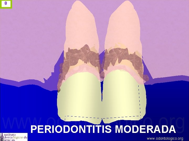 8 PERIODONTITIS MODERADA www. odontologico. org 