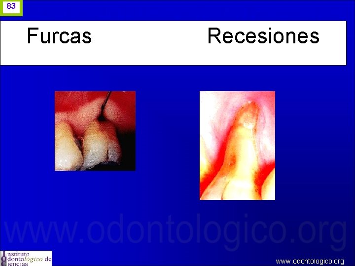 83 Furcas Recesiones www. odontologico. org 