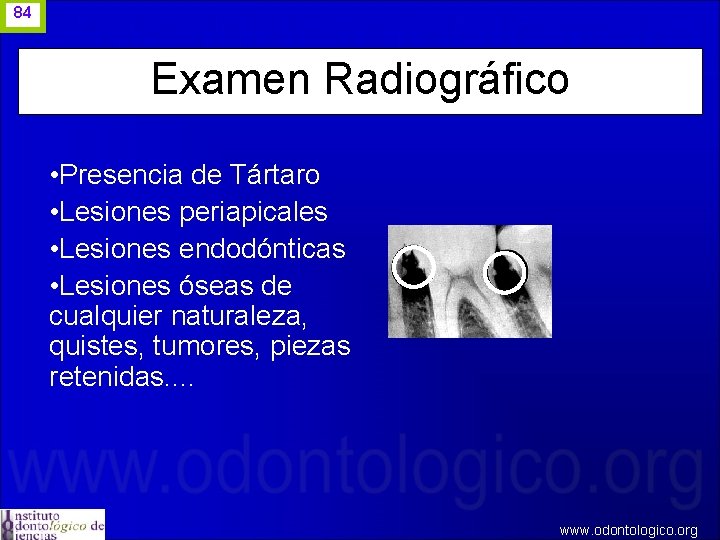 84 Examen Radiográfico • Presencia de Tártaro • Lesiones periapicales • Lesiones endodónticas •