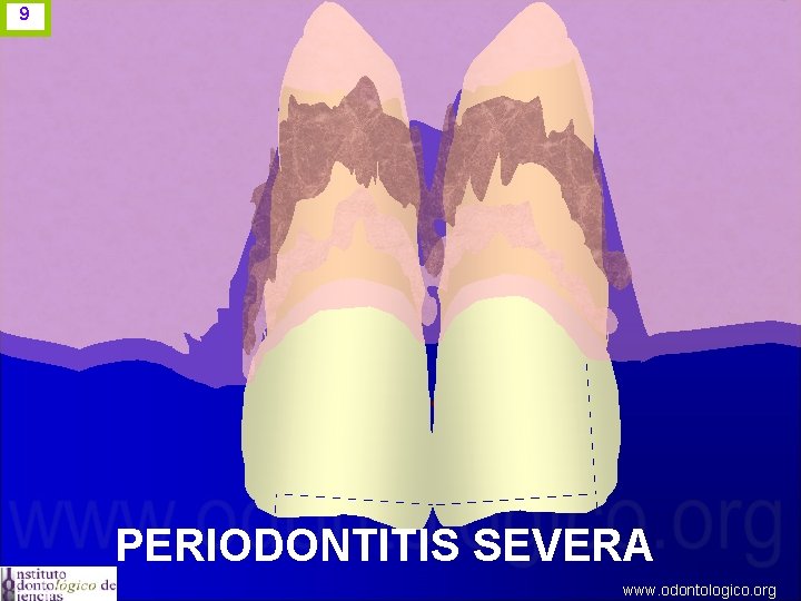 9 PERIODONTITIS SEVERA www. odontologico. org 