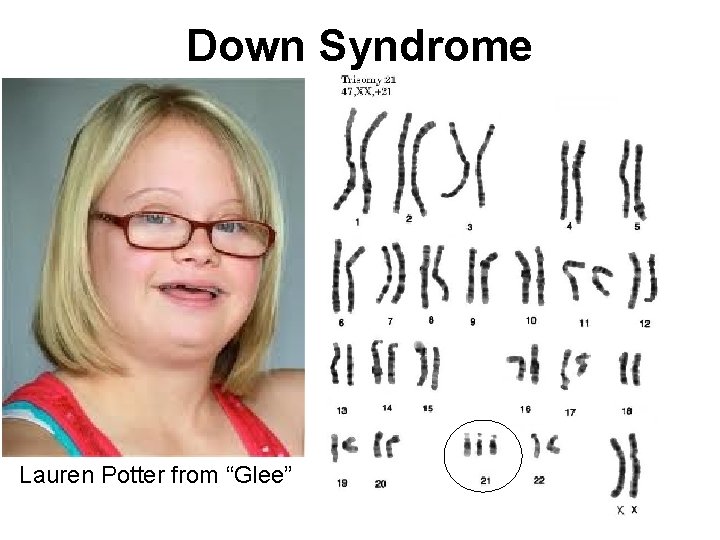 Down Syndrome Lauren Potter from “Glee” 
