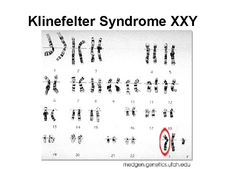 Klinefelter Syndrome XXY 