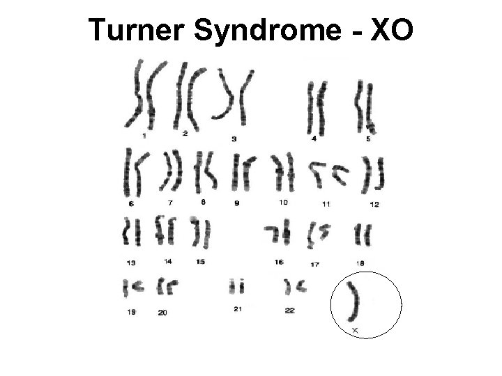 Turner Syndrome - XO 