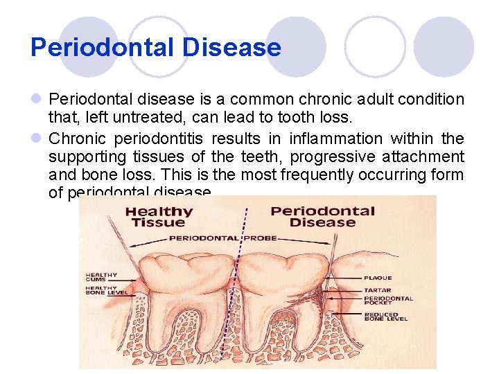 Periodontal Disease l Periodontal disease is a common chronic adult condition that, left untreated,