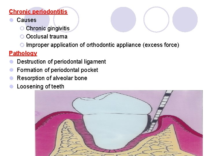 Chronic periodontitis l Causes ¡ Chronic gingivitis ¡ Occlusal trauma ¡ Improper application of